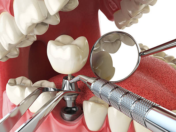 Best Lost Filling or Crown Replacement in Fort Wayne, IN